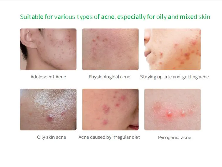 High Quality Hydrocolloid Pimple Patch: Miracle Acne Spot Treatment Sale