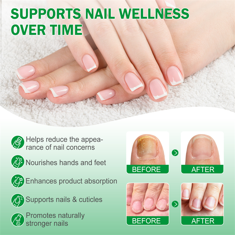 Elaimei 7 Days Nail Fungus Treatment Serum Hands Feet Nourishing Damaged Nails Cuticles Repairing Nails Strengthening Liquid