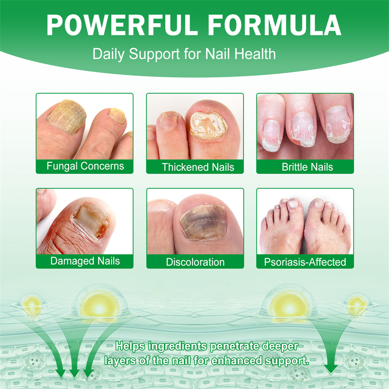 Elaimei 7 Days Nail Fungus Treatment Serum Hands Feet Nourishing Damaged Nails Cuticles Repairing Nails Strengthening Liquid