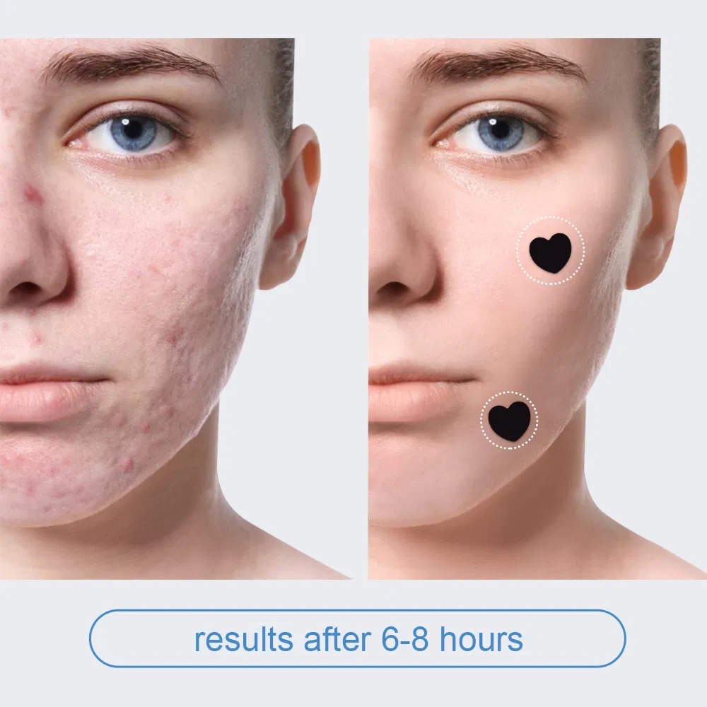 Best Selling 20 Dots Absorbing Pimple Patches Hydrocolloid Spot Treatment