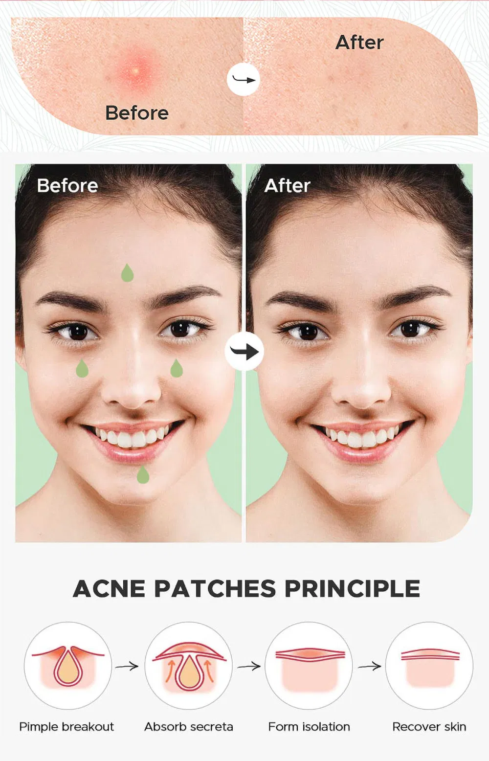 Customized Acne Pimple Treatment with Mirror Hydrocolloid Deep Skin Care Best Sell