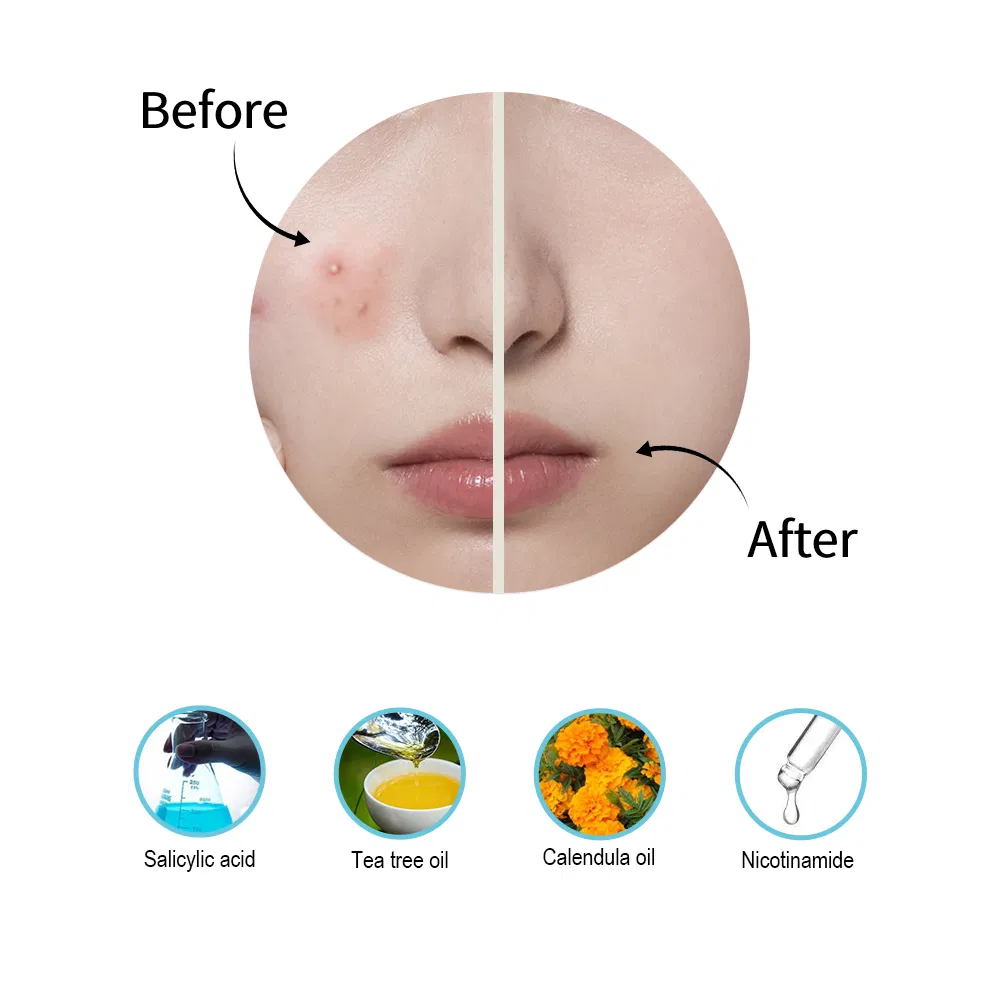 Private Label Custom Hydrocolloid Acne Patches