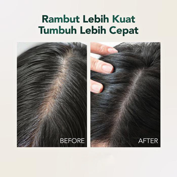 Herbal Dandruff Treatment Soap 200g Relieves Dry Scalp &amp; Reduces Flakes
