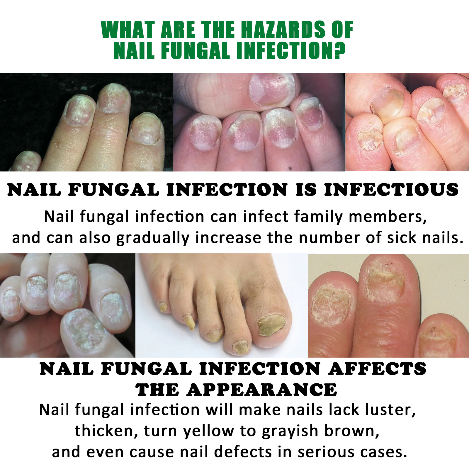 JAYSUING 7 Days Foot Hand Care Ginger Fungus Treatment Nail Fungal Cuticle Serum 30ml