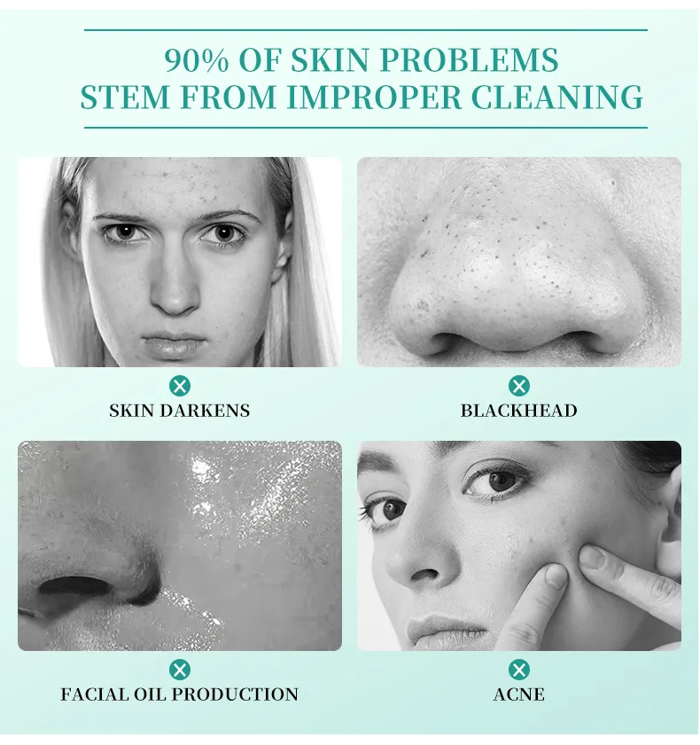 Acne Face Cream 30g Hydrating Anti-Acne Treatment Cream for Blemish Care & Oil Control