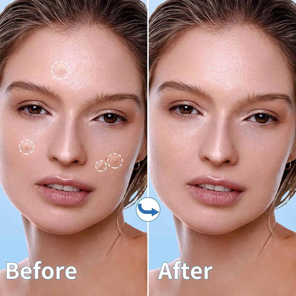 Customized Acne Pimple Treatment with Mirror Hydrocolloid Deep Skin Care Best Sell