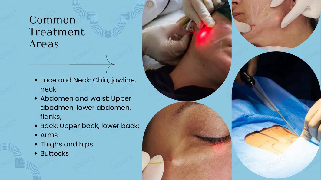 Laser Lipolysis Theory