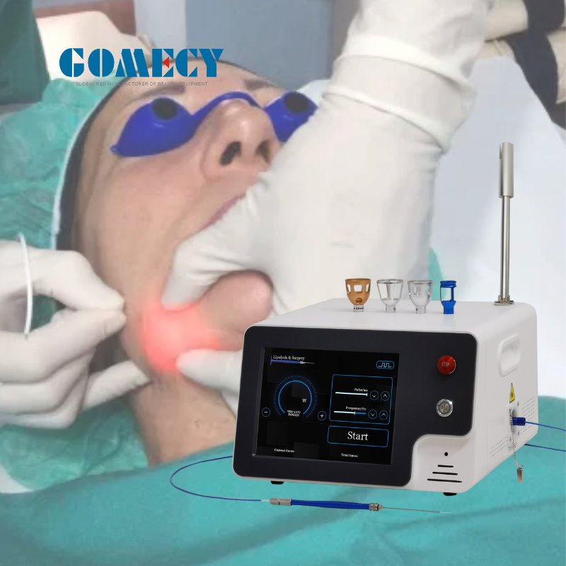 Gomecy Laser Liposuction Machine 1470nm Endolifting Diode Laser Face Lifting