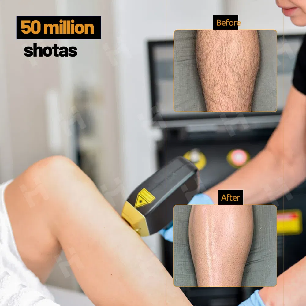 Medical CE FDA Laser Hair Removal Machine AI Intelligent Hair Analysis Painless 808nm Hair Removal Diode Laser